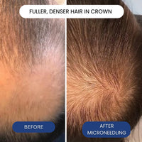 Hairline Renewal Micro-Infusion System