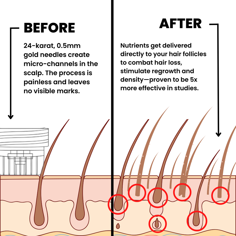 Hairline Renewal Micro-Infusion System